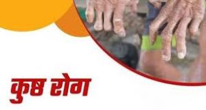 राजनांदगांव जिले में सघन कुष्ठ जांच खोज अभियान 31 दिसंबर तक राजनांदगांव जिले में सघन कुष्ठ जांच खोज अभियान 31 दिसंबर तक