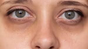 आंखों के नीचे डार्क सर्कल? ये 3 घरेलू नुस्खे अपनाएं आंखों के नीचे डार्क सर्कल? ये 3 घरेलू नुस्खे अपनाएं