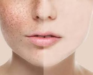   पुरानी से पुरानी झाइयों को जड़ से खत्म कर देंगे ये 5 घरेलू उपाय 