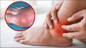 स्किन पर दिखते हैं यूरिक एसिड बढ़ने के ये चार लक्षण