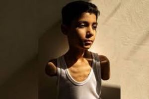 इजराइल के हमले में दोनों हाथ गंवाने वाले फलस्तीनी लड़के की तस्वीर को मिला पुरस्कार