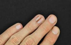 साग काटने से हाथ कट-फटकर नाखून काले पड़ गए तो ऐसे करें देखभाल साग काटने से हाथ कट-फटकर नाखून काले पड़ गए तो ऐसे करें देखभाल