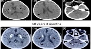 भारतीय वैज्ञानिकों ने बच्चों में दुर्लभ USP18 जीन म्यूटेशन की पहचान की भारतीय वैज्ञानिकों ने बच्चों में दुर्लभ USP18 जीन म्यूटेशन की पहचान की